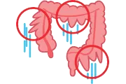 constipation_8_1_colondilation