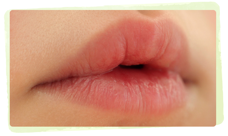 Dry Lips